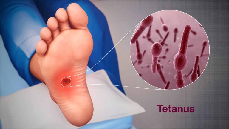 Fakta Penting tentang Tetanus yang Perlu Anda Ketahui